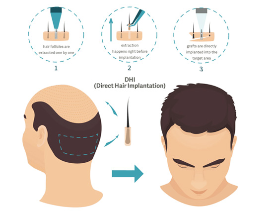 Best hair Transplant Treatment in Mumbai, Hair Treatment at Affordable Price Cost India by Dr Debraj Shome at The Esthetic Clinics