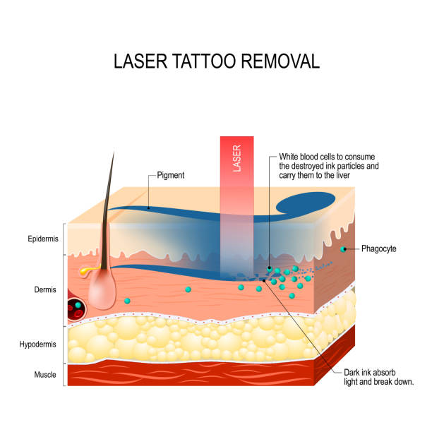 Best Laser Tattoo Removal Treatment in Mumbai at Affordable Price Cost India by Dr Rinky Kapoor at The Esthetic Clinics