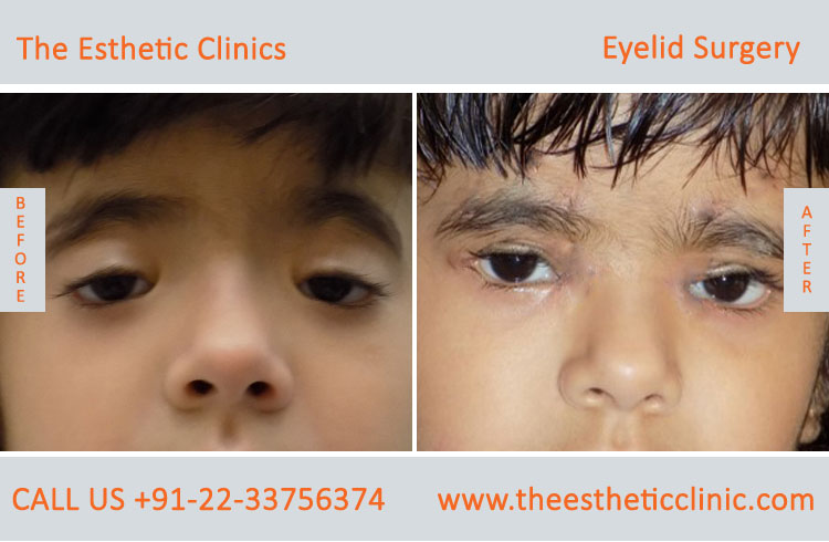 Eyelid Surgery in Mumbai, Best Eyelid Lift Cost, Surgeons in India - The Esthetic Clinics