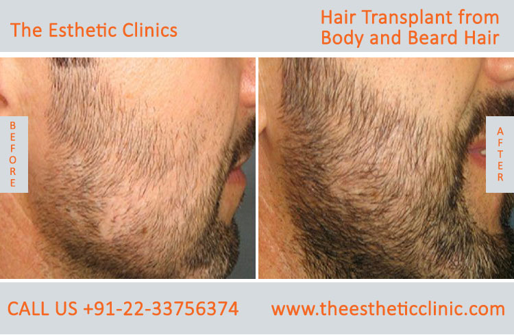 Best Hair Transplant in Mumbai, Body & Beard Hair Transplant to Head India-  The Esthetic Clinics
