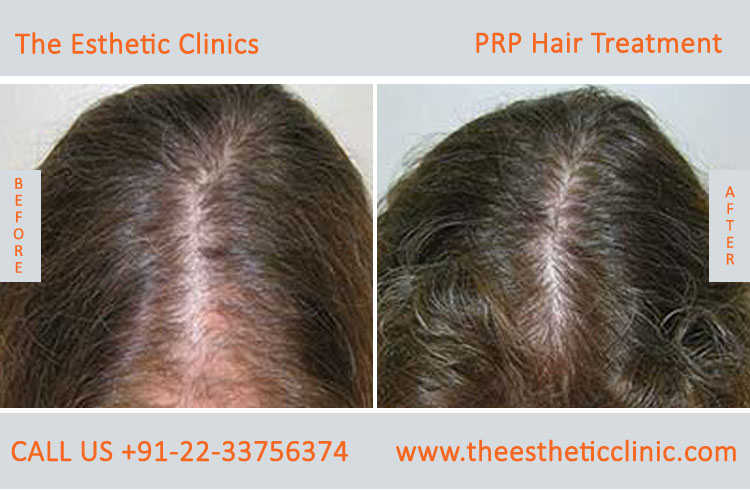 PRP Treatment in Mumbai, PRP Hair Treatment Cost India - The Esthetic  Clinics