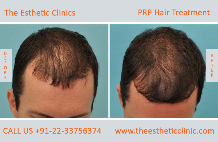 PRP Treatment in Mumbai, PRP Hair Treatment Cost India - The Esthetic  Clinics