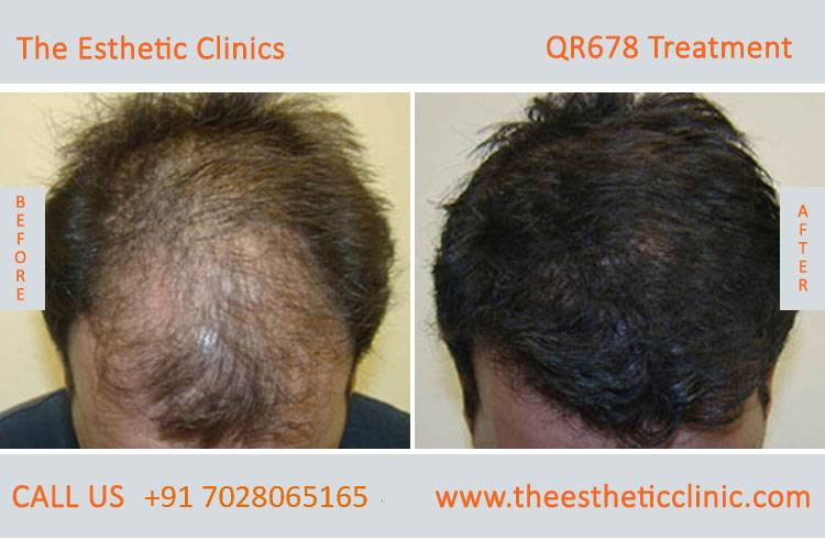 What is QR 678 hair therapy and how much does the treatment cost