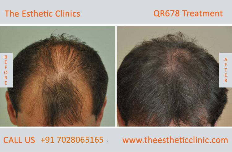 QR678 Treatment, Best Hair Treatment in Mumbai, India - The Esthetic Clinics