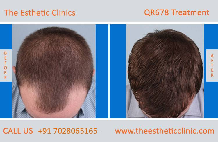 THE PLANT BASED HAIR RESTORATION THERAPY AIDS IN COVID RELATED HAIR LOSS