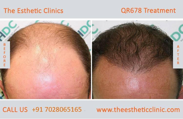 QR678 Treatment, Best Hair Treatment in Mumbai, India - The Esthetic Clinics