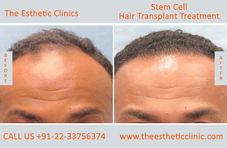 Stem Cells Treatment Mumbai, Stem Cells Therapy Cost India - The Esthetic  Clinics