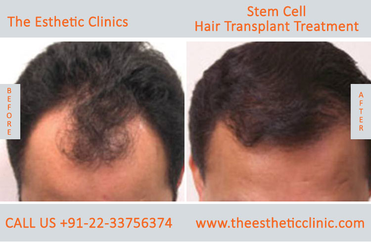 Stem Cells Treatment Mumbai, Stem Cells Therapy Cost India - The Esthetic  Clinics