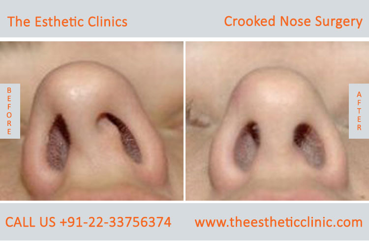 Crooked Nose Surgery before after photos in mumbai india (2)