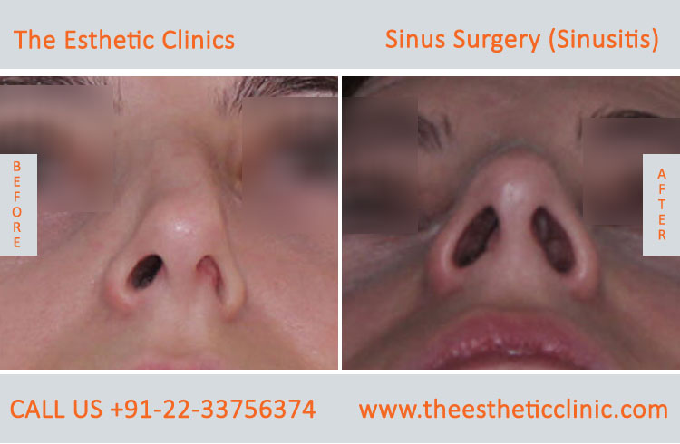 Sinus Surgery, Sinusitis before after photos in mumbai india (4)