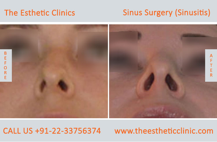Sinus Surgery, Sinusitis before after photos in mumbai india (5)