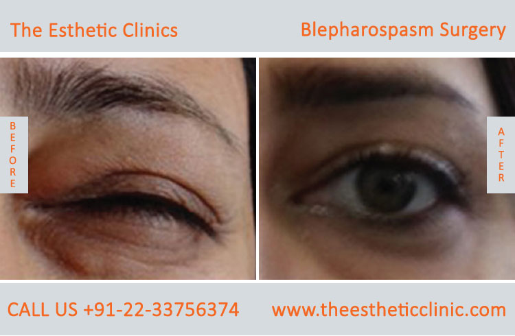 Best Eyelid Disease Surgery | Eyelid Disorder Diagnosis & Management in Mumbai, India