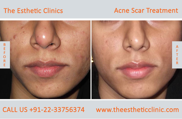 face acne scars removal laser treatment before after photos in mumbai india (1)