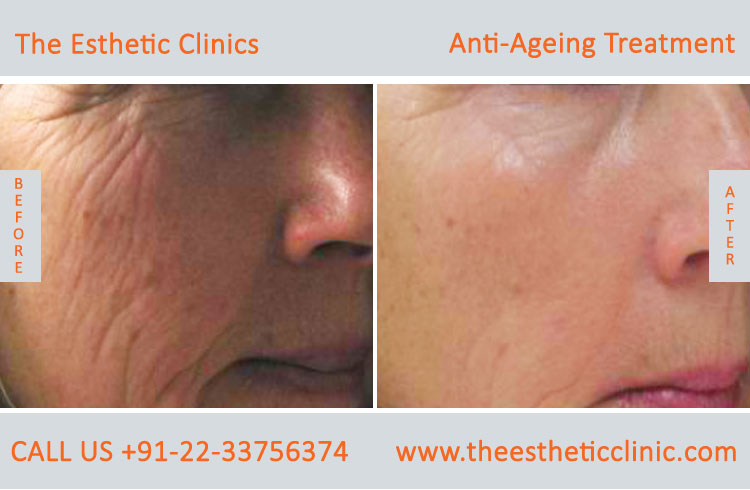Anti Aging Treatment for Face Wrinkles before after photos in mumbai india (1)