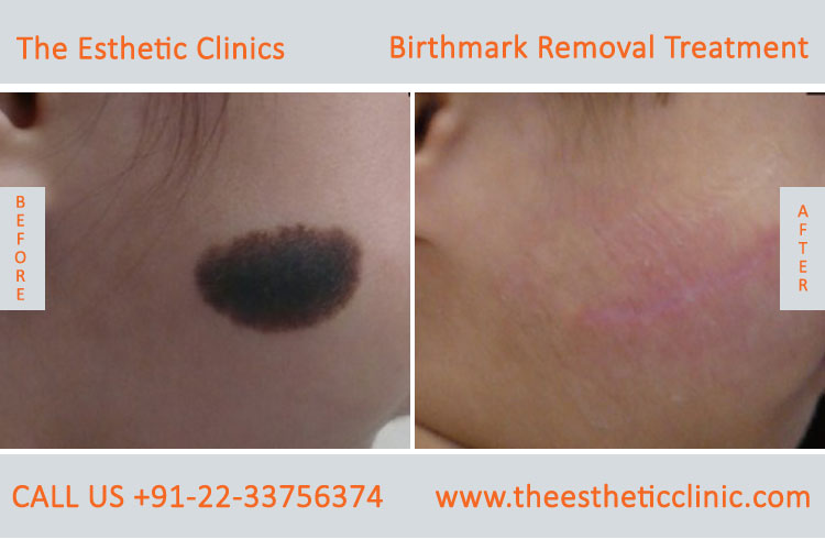 Best Birthmark Removal Treatment in Mumbai