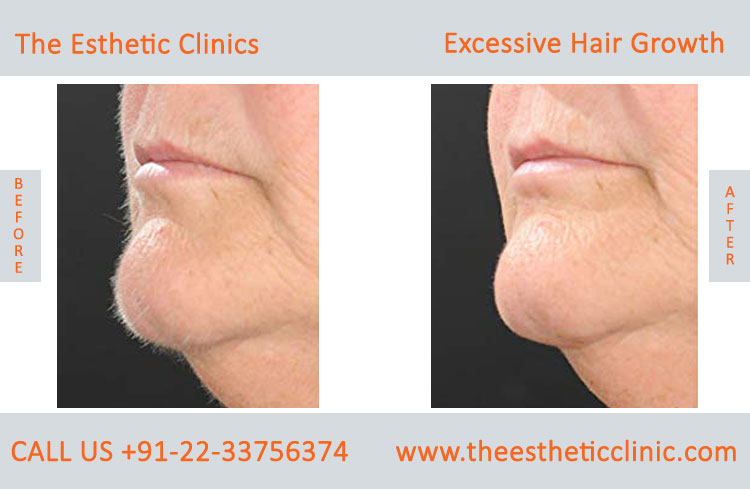 Excessive Hair Growth Removal Treatment, Cost in Mumbai, India - The  Esthetic Clinics