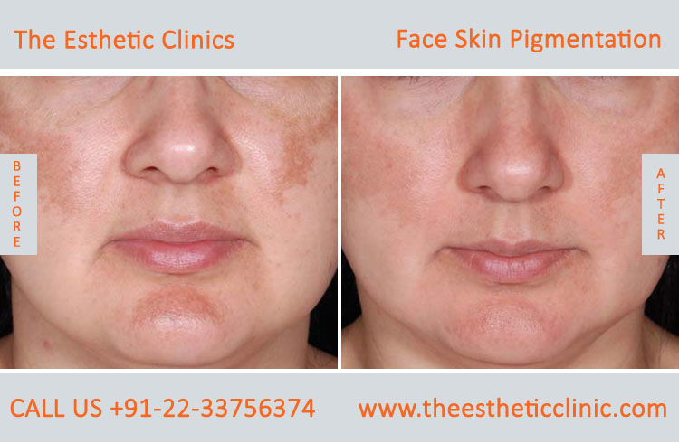 Face Skin Pigmentation Treatment Mumbai, Hyperpigmentation Cost India - The Esthetic Clinics