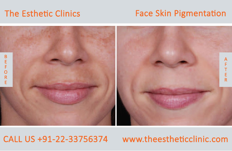 Skjult margen dedikation Face Skin Pigmentation Treatment Mumbai, Hyperpigmentation Cost India - The  Esthetic Clinics