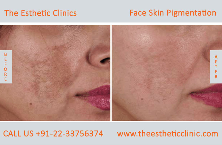 Face Skin Pigmentation Laser Treatment before after photos in mumbai india (6)
