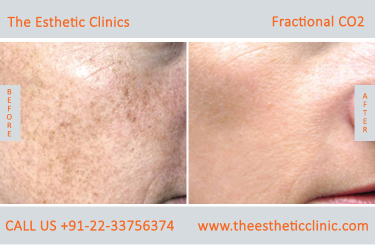 Fractional Co2 Laser Skin Resurfacing Treatment before after photos in mumbai india (3)