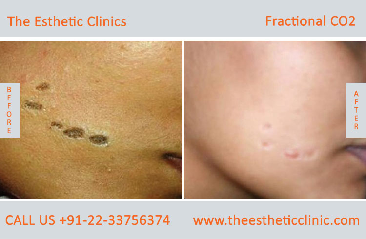 Fractional Co2 Laser Skin Resurfacing Treatment before after photos in mumbai india (6)