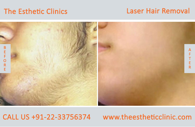 Permanent Laser Hair Removal Treatment before after photos in mumbai india (1)