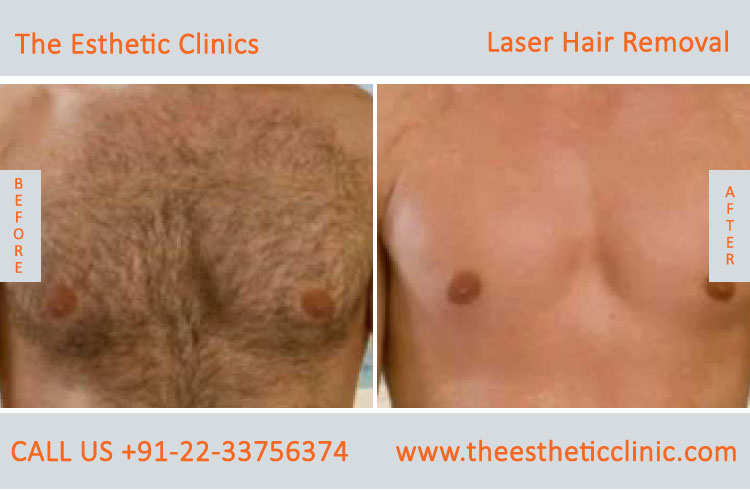 Permanent Laser Hair Removal Treatment before after photos in mumbai india (6)