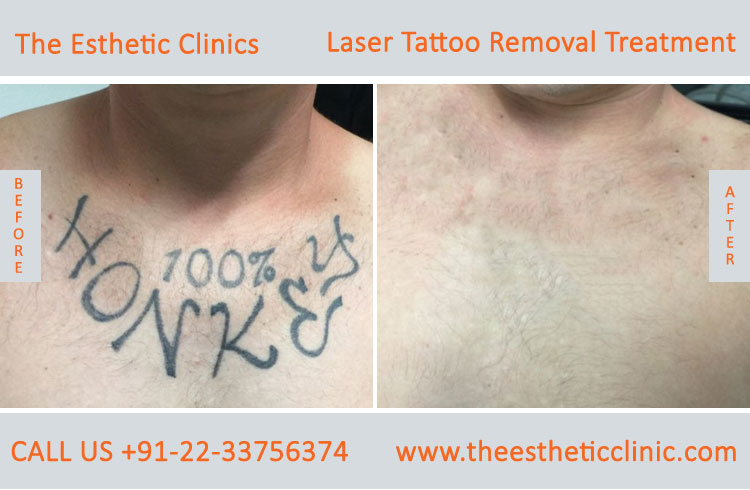 Best Tattoo Removal and Tattoo Removal Cost in Delhi  Desmoderm