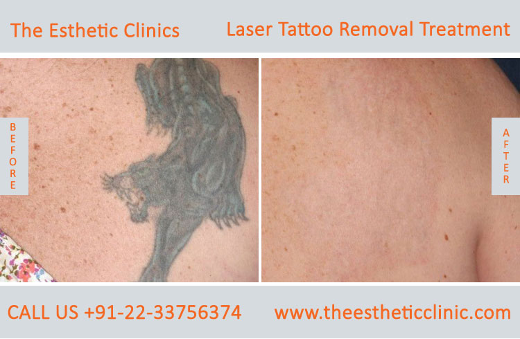Tattoo Removal Mumbai, Permanent Laser Tattoo Removal Treatment Cost India  - The Esthetic Clinics