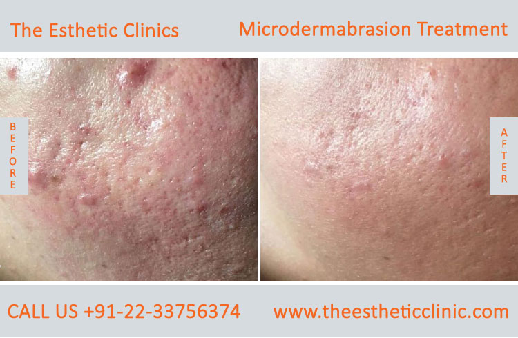 Microdermabrasion Dermabrasion Treatment before after photos in mumbai india (1)