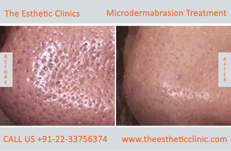 Microdermabrasion Dermabrasion Treatment before after photos in mumbai india (6)