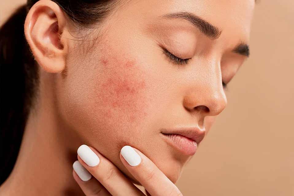 Acne Treatment Mumbai, Pimples, Acne Scars Clinics, Cost India - The Esthetic Clinics