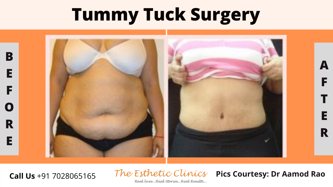 Best Body Contouring Surgery Treatment before after photos in Mumbai, India