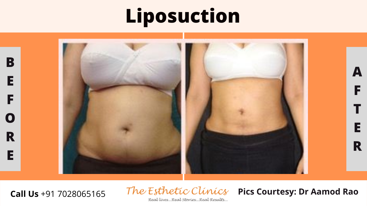 Best Body Contouring Surgery Treatment before after photos in Mumbai, India
