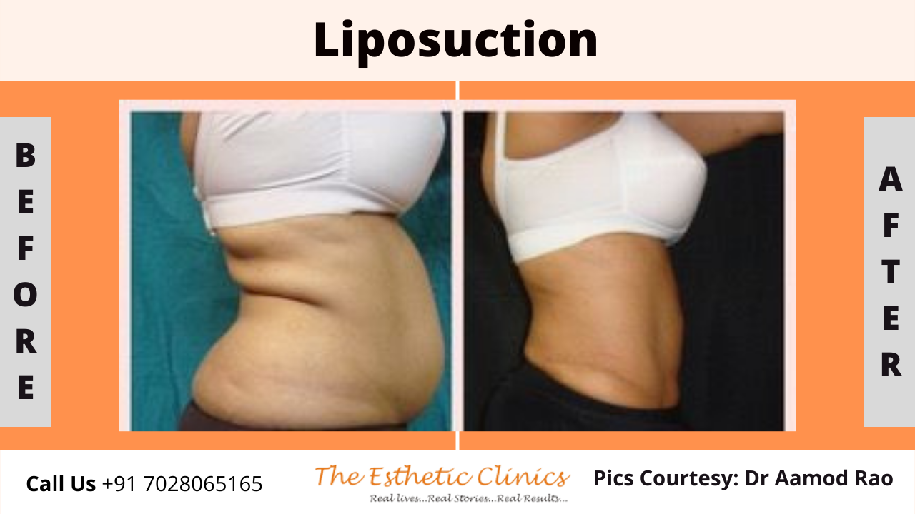 Body Contouring Surgery in Mumbai, Coolsculpting Cost India - The