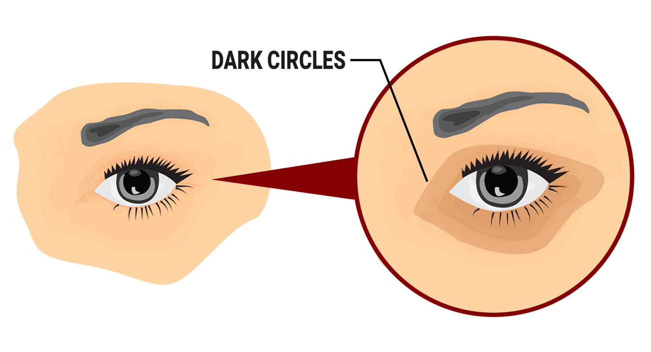 Dark Circles Under Eyes Treatment London & Bucks | The Cosmetic Skin Clinic