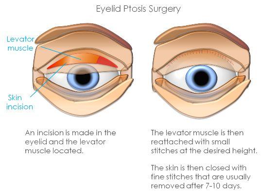 Best Eyelid Ptosis Surgery in Mumbai, Eyelid Treatment at Affordable Price Cost India by Dr Debraj Shome at The Esthetic Clinics