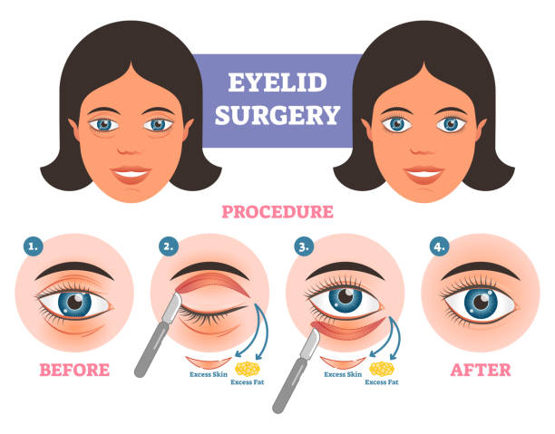 Best Eyelid Surgery in Mumbai, Eyelid Surgery at Affordable Price Cost India by Dr Debraj Shome at The Esthetic Clinics