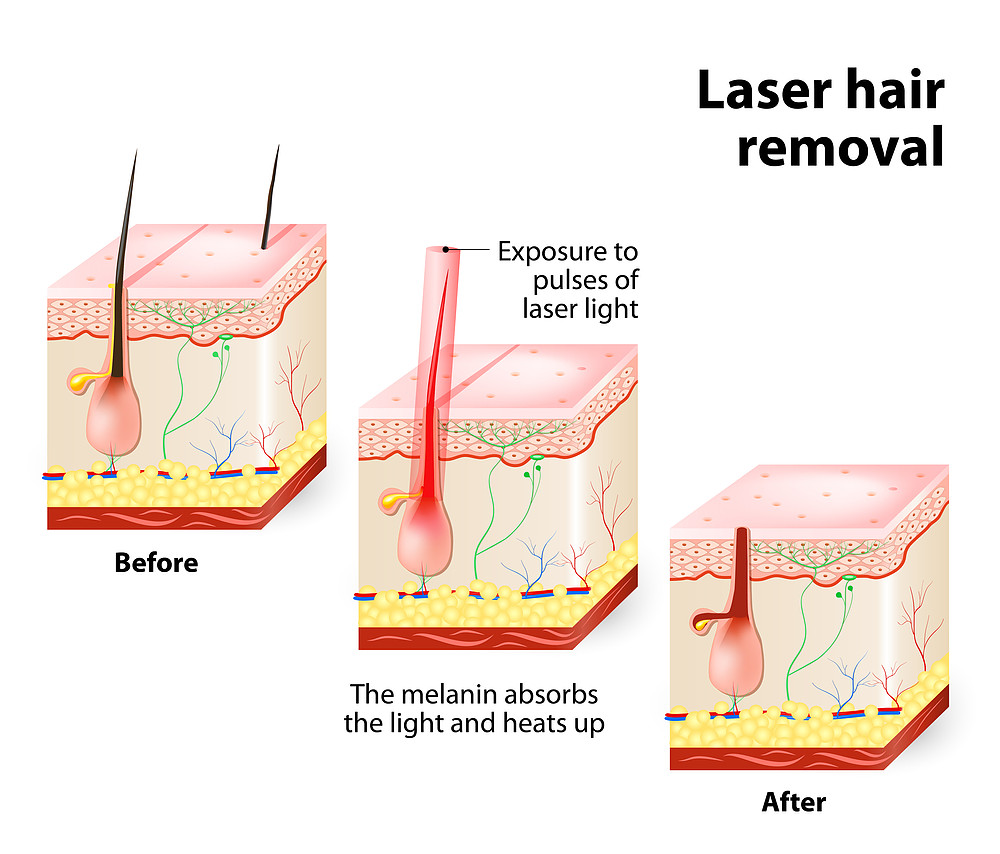 Best Laser Hair Removal Treatment in Mumbai at Affordable Price Cost India by Dr Rinky Kapoor at The Esthetic Clinics