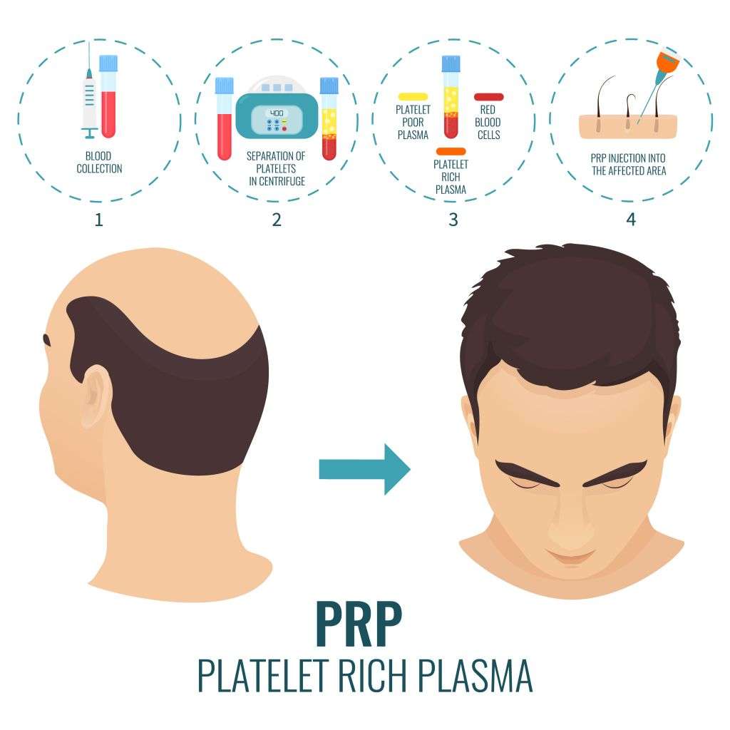 How to get back tresses with PRP hair restoration?