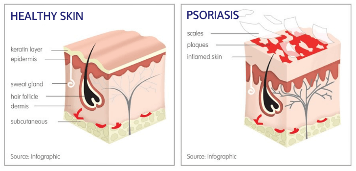 Best Psoriasis Treatment in Mumbai at Affordable Price Cost India by Dr Rinky Kapoor at The Esthetic Clinics
