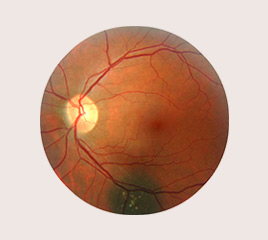 Retinal Tumour