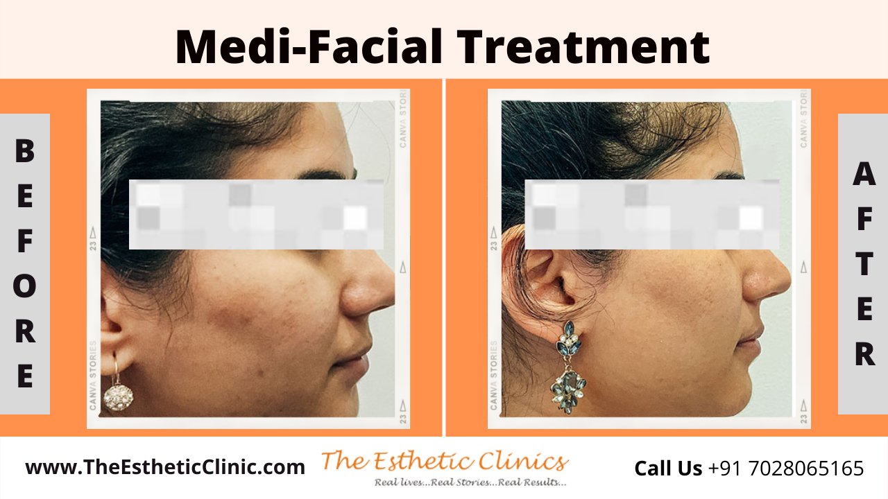 Best Medi-Facial Treatment in Mumbai (Skin Glow)