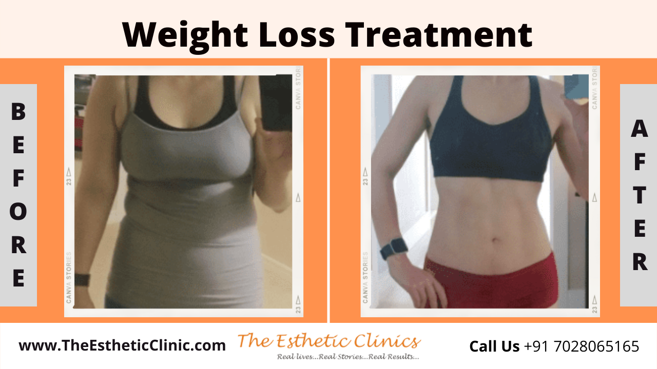 Non-Surical Weight Loss Treatment before after photos in mumbai india