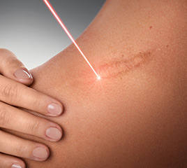 Laser Scar Reduction